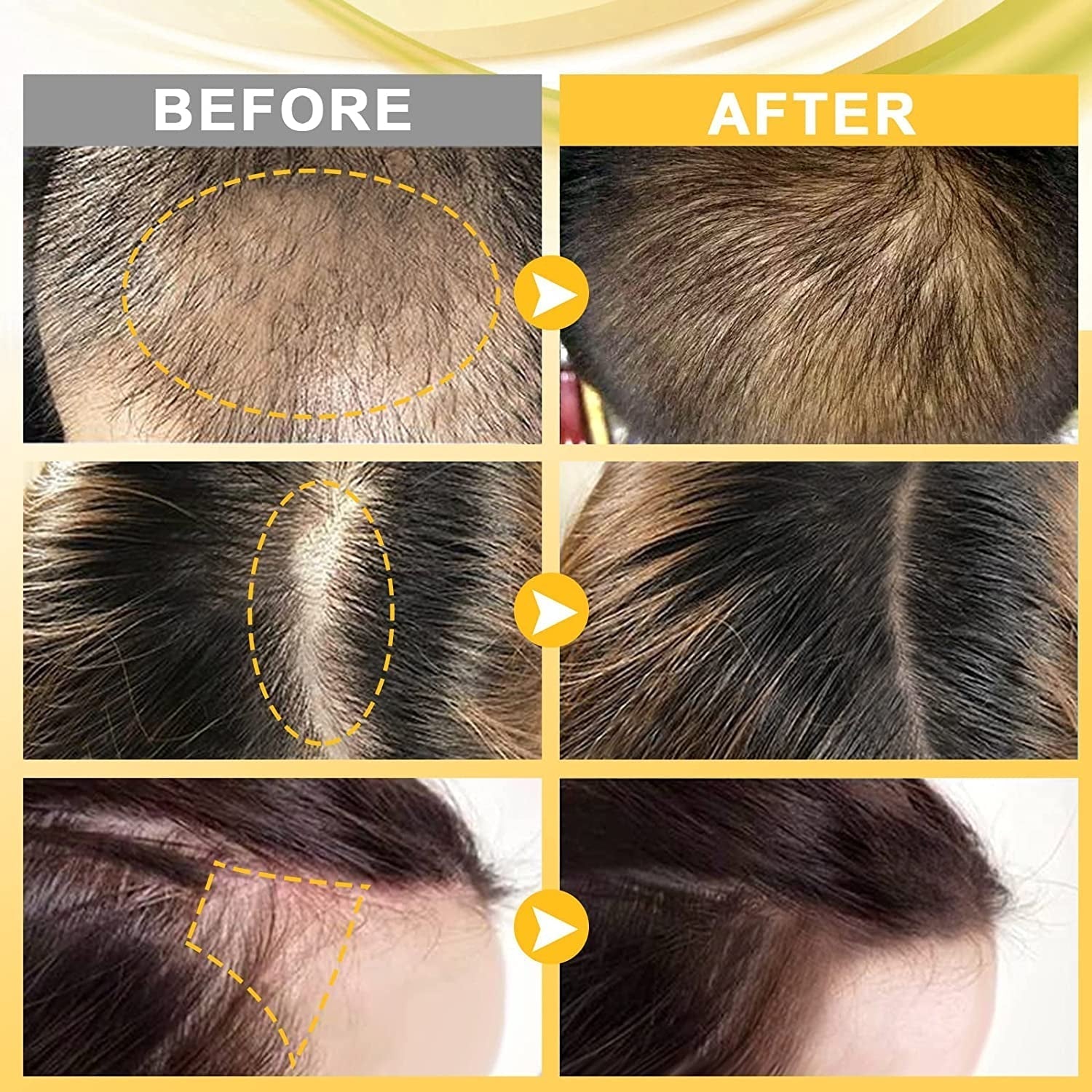 Dermaroller Set 0.5mm Microneedling Skin Roller cu ser de creștere a părului, anti-pierdere a părului, 30ML , Căderea părului și tratamentul părului Ingrijirea parului Naty Shop