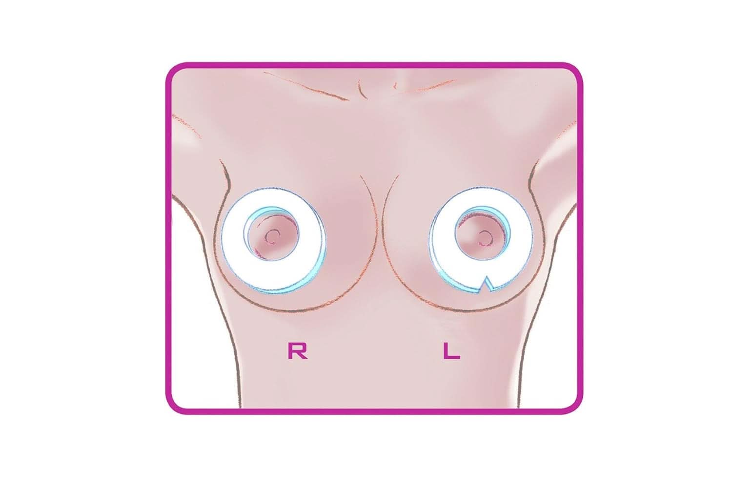 ELANEE Brust-Ringe, Schutz Der Brustwarze Bh-Kontakt Durch Hohllagerung, Ideal Bei Wunden, Entzündeten Brustwarzen Durch Stillen, 10 Stück (222-00) Accesorios Alimentación y Lactancia Bebe Naty Shop